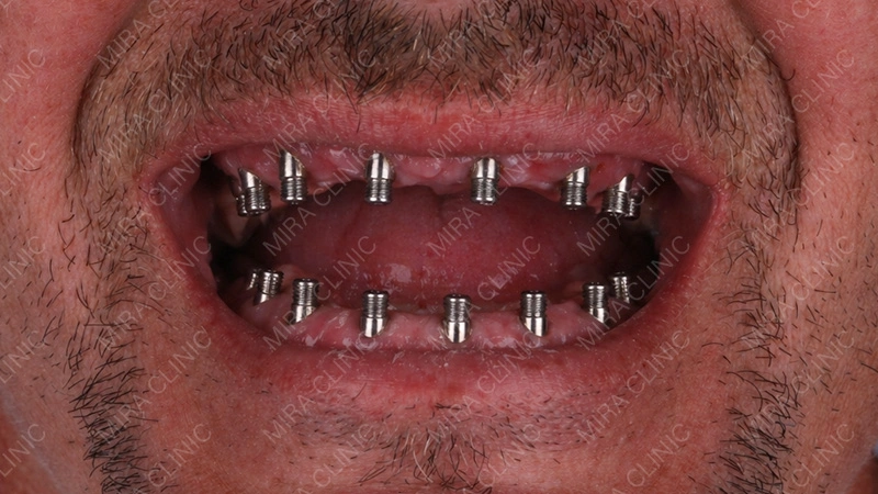Full Extraction and 14 Implants
